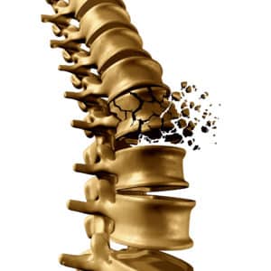 fractura-vertebral