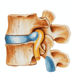 hernia-discal-lumbar